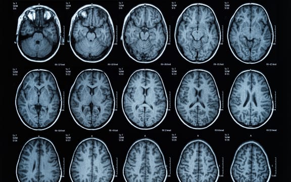 health medical image of an mri of the head showing the brain. Magnetic resonance image.