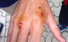 V8 Supercars champion Jamie Whincup tweeted a photo of his snake bite.