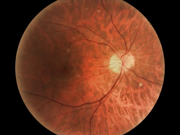 Retina