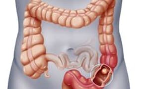 Bowel Cancer