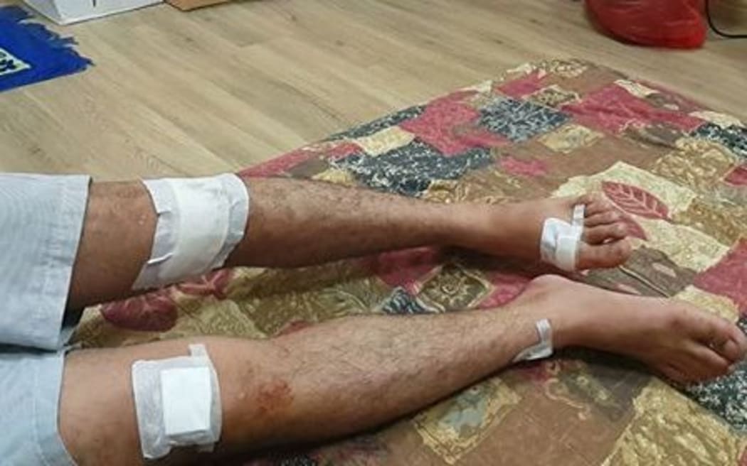 Some of the refugees say they were injured during the forced removal.