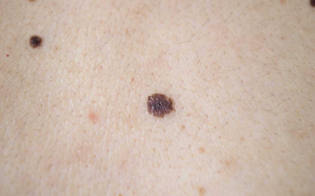 melanoma - skin cancer on a man's back