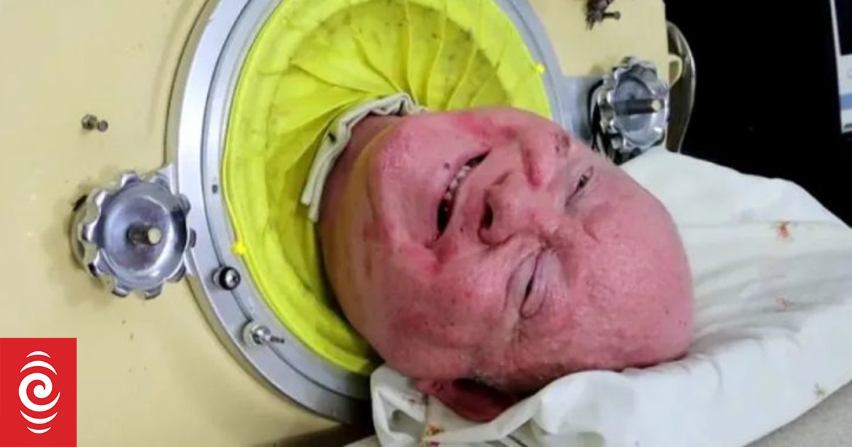 Paul Alexander: „Człowiek w żelaznych płucach” umiera w wieku 78 lat