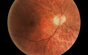 Retina