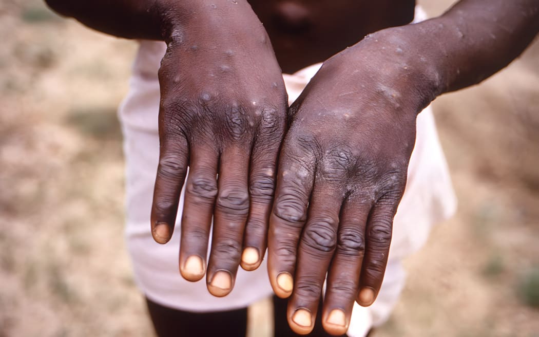 Human mpox case. The backs of the hands of a patient with mpox showing a characteristic rash during his recovery phase. Monkeypox outbreak in the Democratic Republic of the Congo (DRC), 1996-1997, formerly in Zaire.