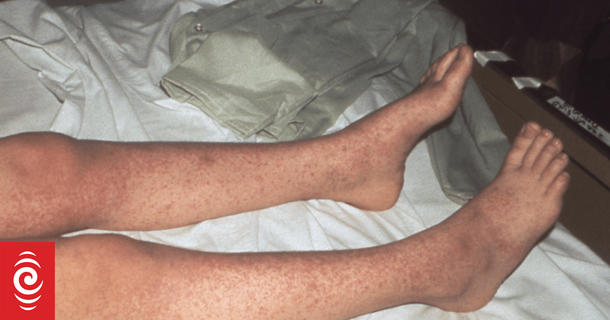 New measles case in Wellington | RNZ News