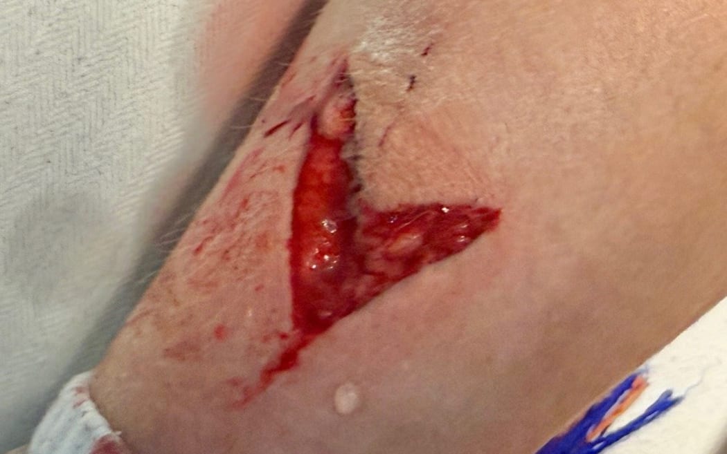 Jude Beattie's injury.
