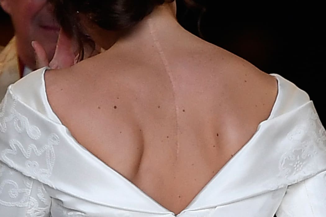 The scar on the back of Britain's Princess Eugenie of York is clearly visable as she arrives for her wedding to Jack Brooksbank at St George's Chapel, Windsor Castle.