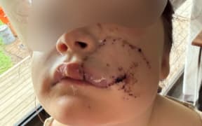 Dog attack - child victim blurred - 3 March 2026