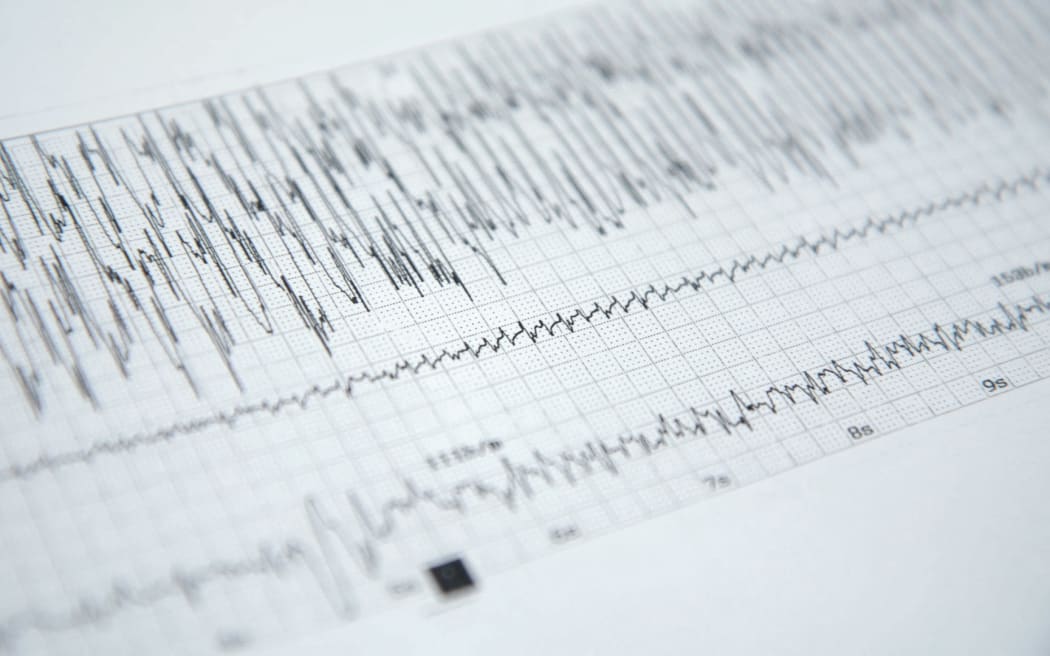 A print out from one of Kerry Hodgson's many ECT treatments - electroencephalograms, or EEGs, recording Kerry’s brain activity during each of her ECT shocks.