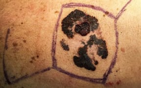 Blotchy dark brown raised  melanoma