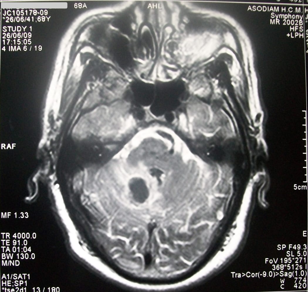Stroke in MRI