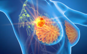 Breast cancer can spread within the body if not stopped by treatment
