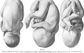 Illustration from Ernst Bumm and Albrecht Mayer - Grundriss zum Studium der Geburtshülfe 1902
