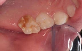 A tooth affected by molar-hypomin or Chalky teeth