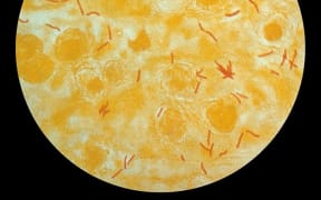 Photomicrograph of a sputum sample containing Mycobacterium tuberculosis.