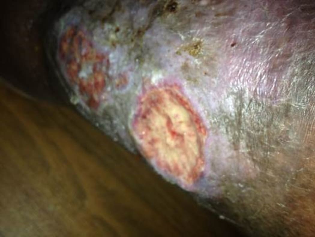 The man's leg wound.