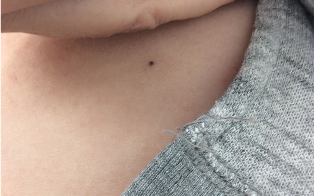 A person lifts up their shirt to show a small black dot on their skin; a tattoo left over from cancer radiation treatment.