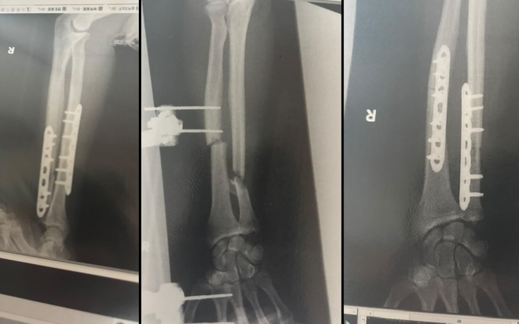 X-rays showing the repair work on Billy Halloran's arm.