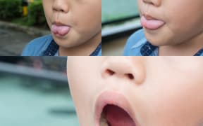 Ankyloglossia or tongue tie.