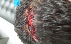 An Iranian refugee who says he was attacked by two Nauru men