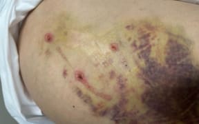 Rotorua resident Peti Waaka was attacked by four dogs in 2023 and DNA helped identify them.