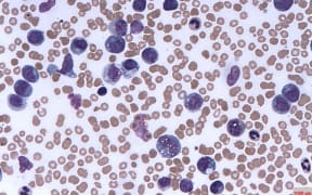 Leukaemia cells