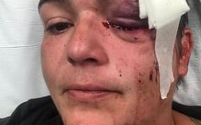 Linda Turado in hospital after a rubber bullet hit her in the eye