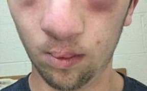 Andrew Seely's face became swollen after peanut butter was allegedly rubbed on his face by another student.