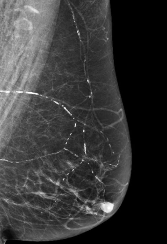 Breast scan image