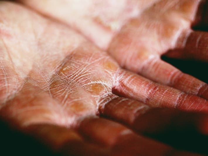 One in three New Zealanders will be at some stage affected by atopic eczema - a skin condition that causes dry, itchy, inflamed skin.