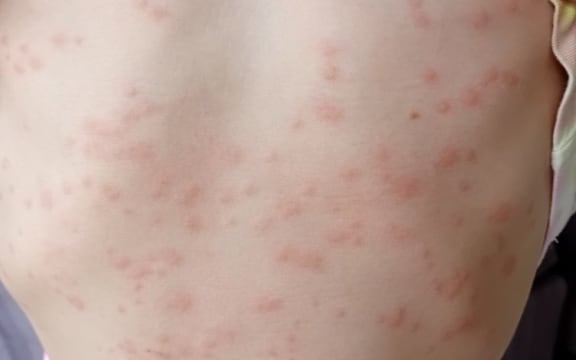 Sea bather's eruption on a child after swimming at Takapuna Beach.