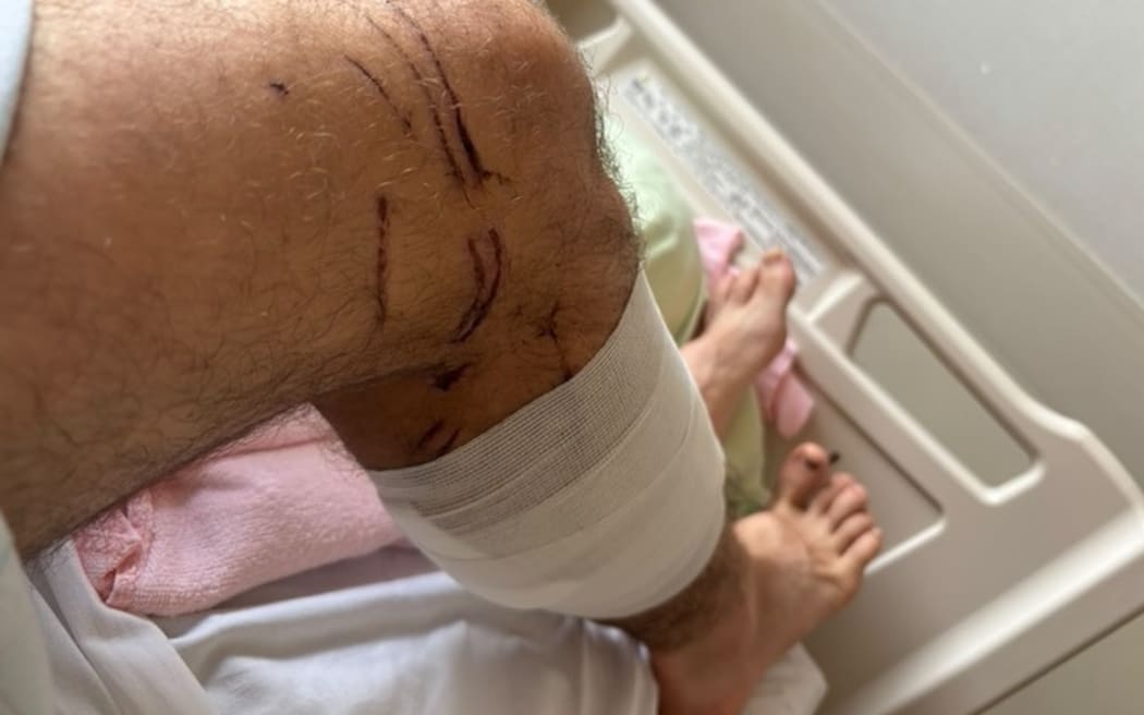 The wounds on Billy Halloran's leg after the attack.