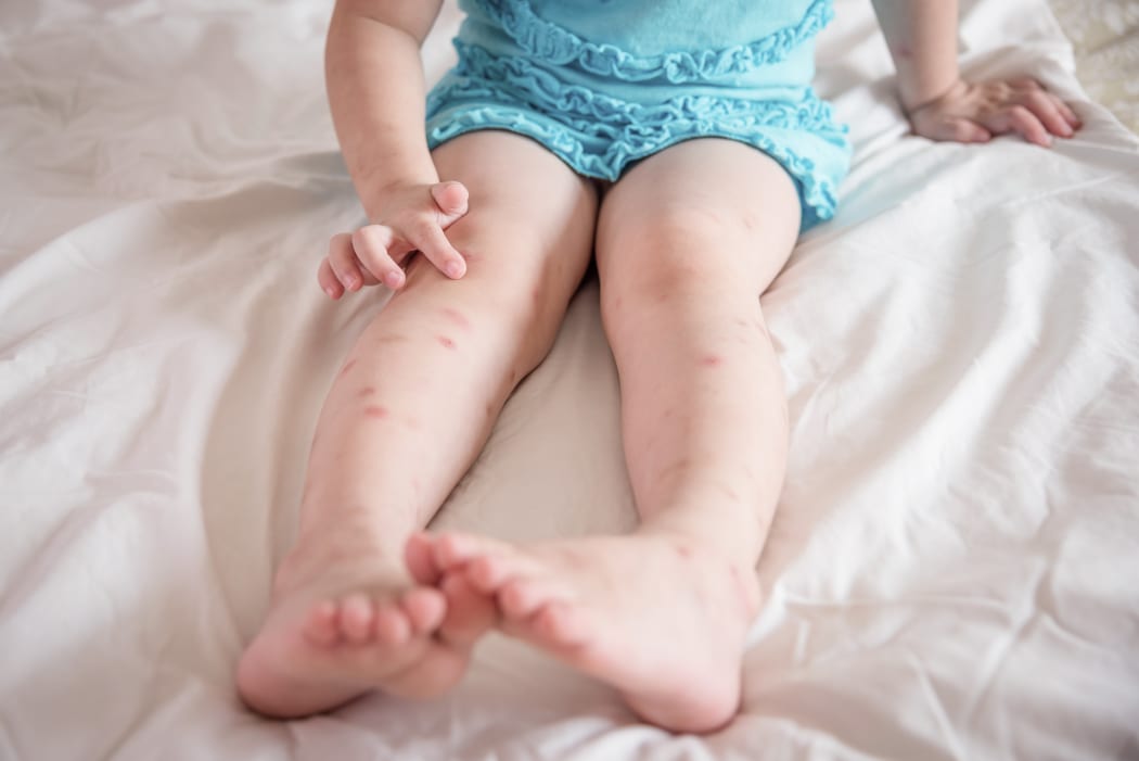 rash, bites, sea borne, sea lice rash
