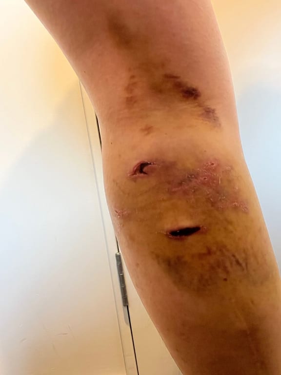 Rotorua resident Peti Waaka was attacked by four dogs in 2023 and DNA helped identify them.