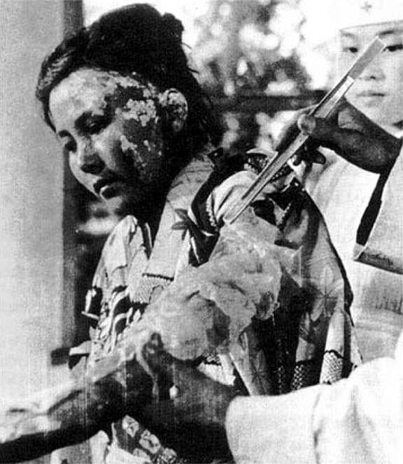 22-year old victim Toyoko Kugata being treated at the Hiroshima Red Cross Hospital (October 6, 1945)