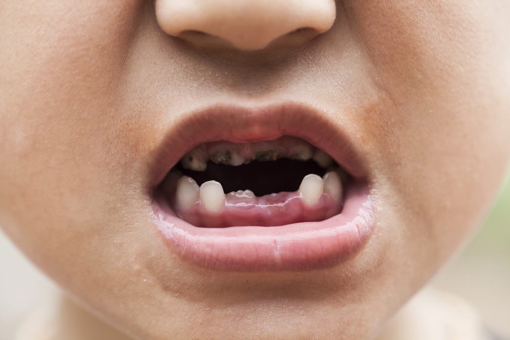 A child's mouth showing rotten and decaying teeth.