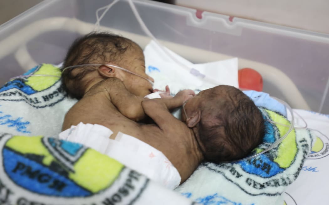 Tom and Sawong are joined at the abdomen and are being treated in Port Moresby General Hospital's neonatal unit.
