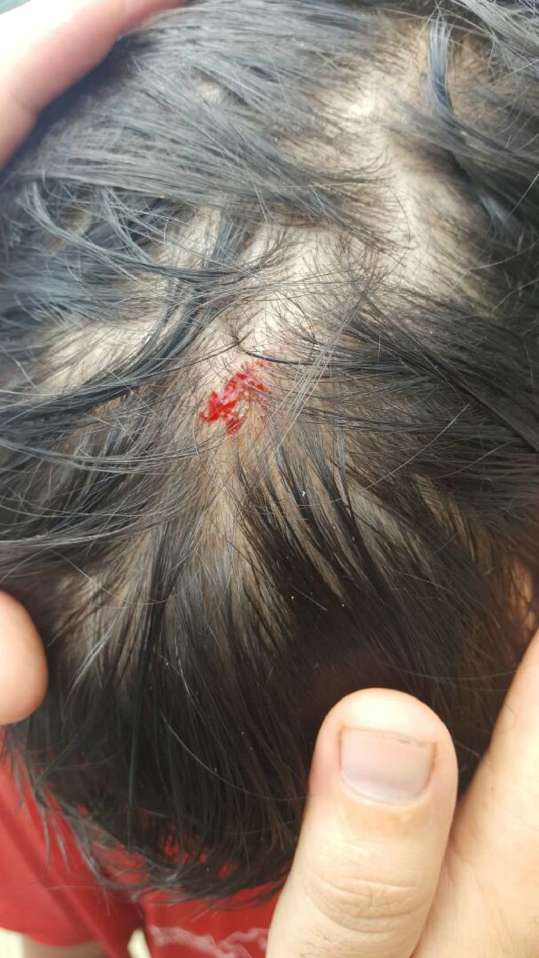 Manus refugee hurt during police assault