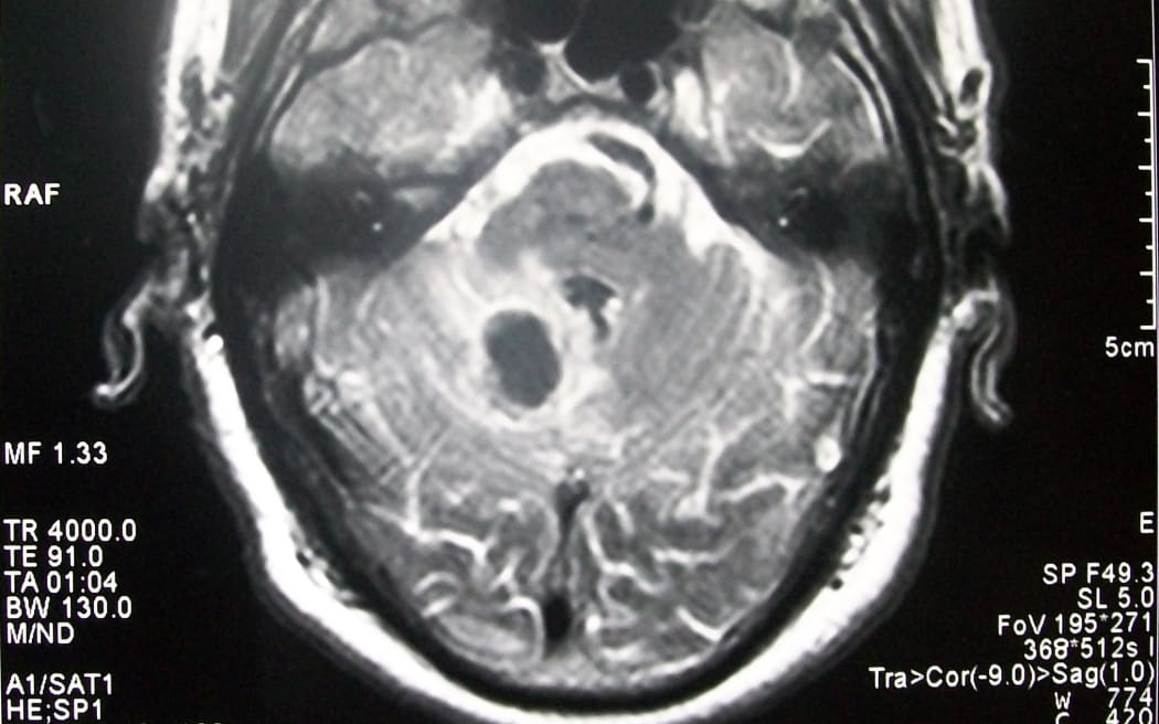 Stroke in MRI