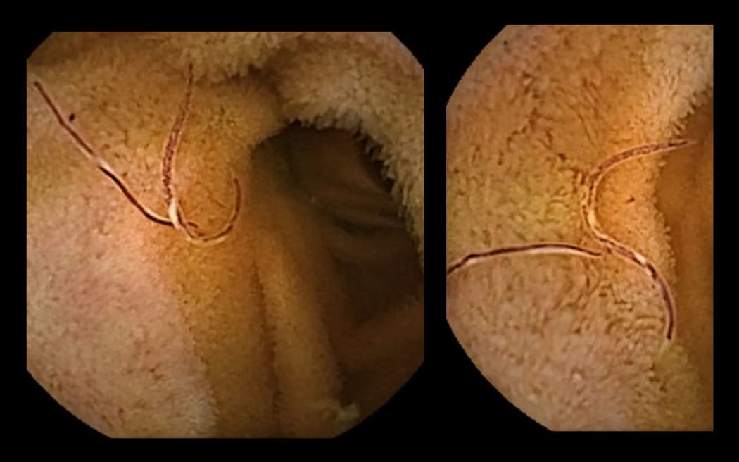 Photographs of hookworms in the small intestine taken with a pill camera