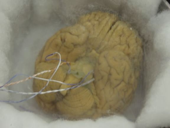 Vitrified human brain of an Alcor patient