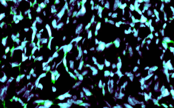 Nanoparticles in Glioma Cell Nuclei