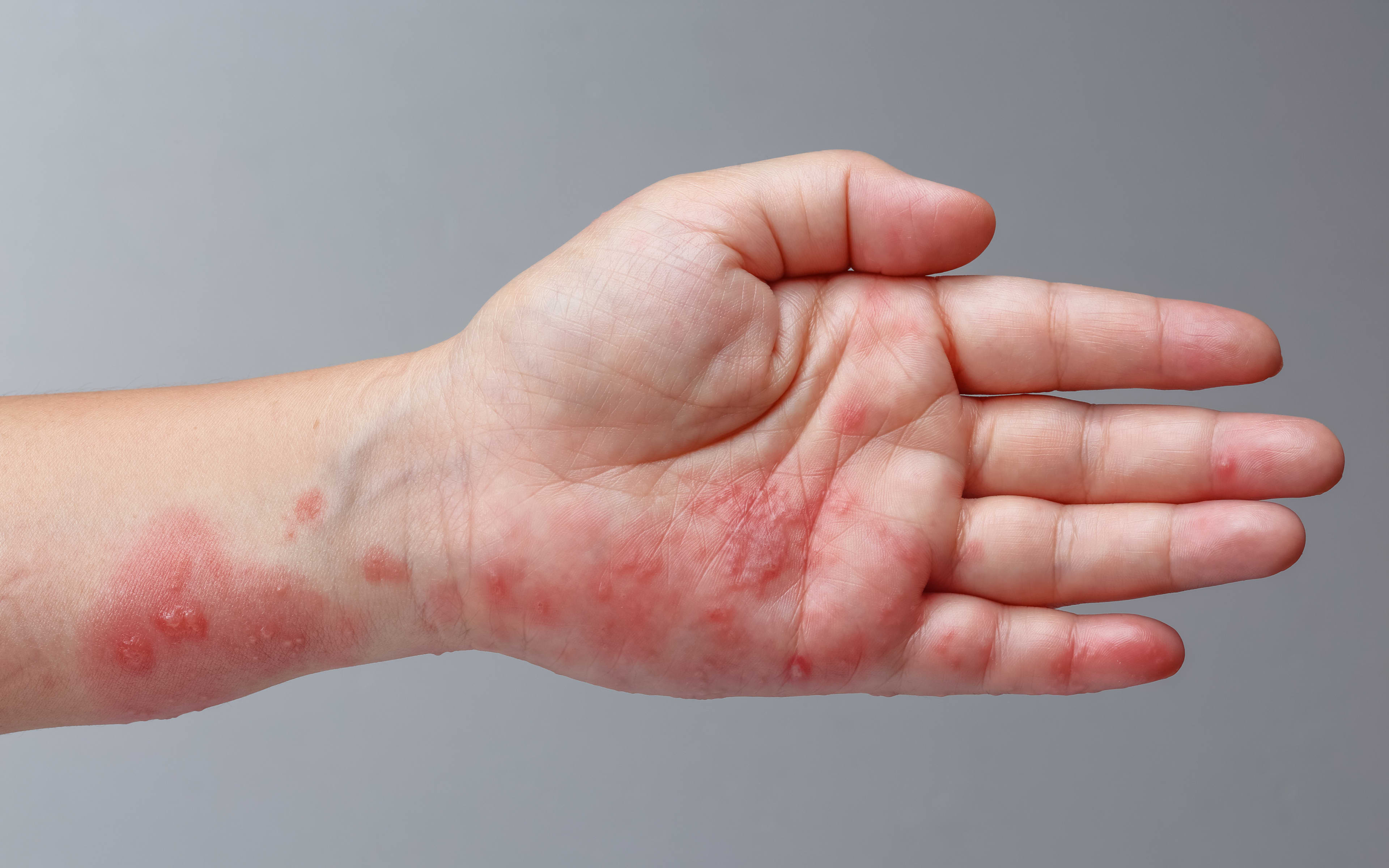 Cover art for Specialist pain doctors call for free shingles vaccine