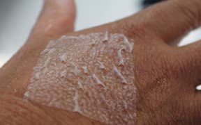 A wound care product made with sheep stomach - by Auckland-based manufacturer Aroa Biological
