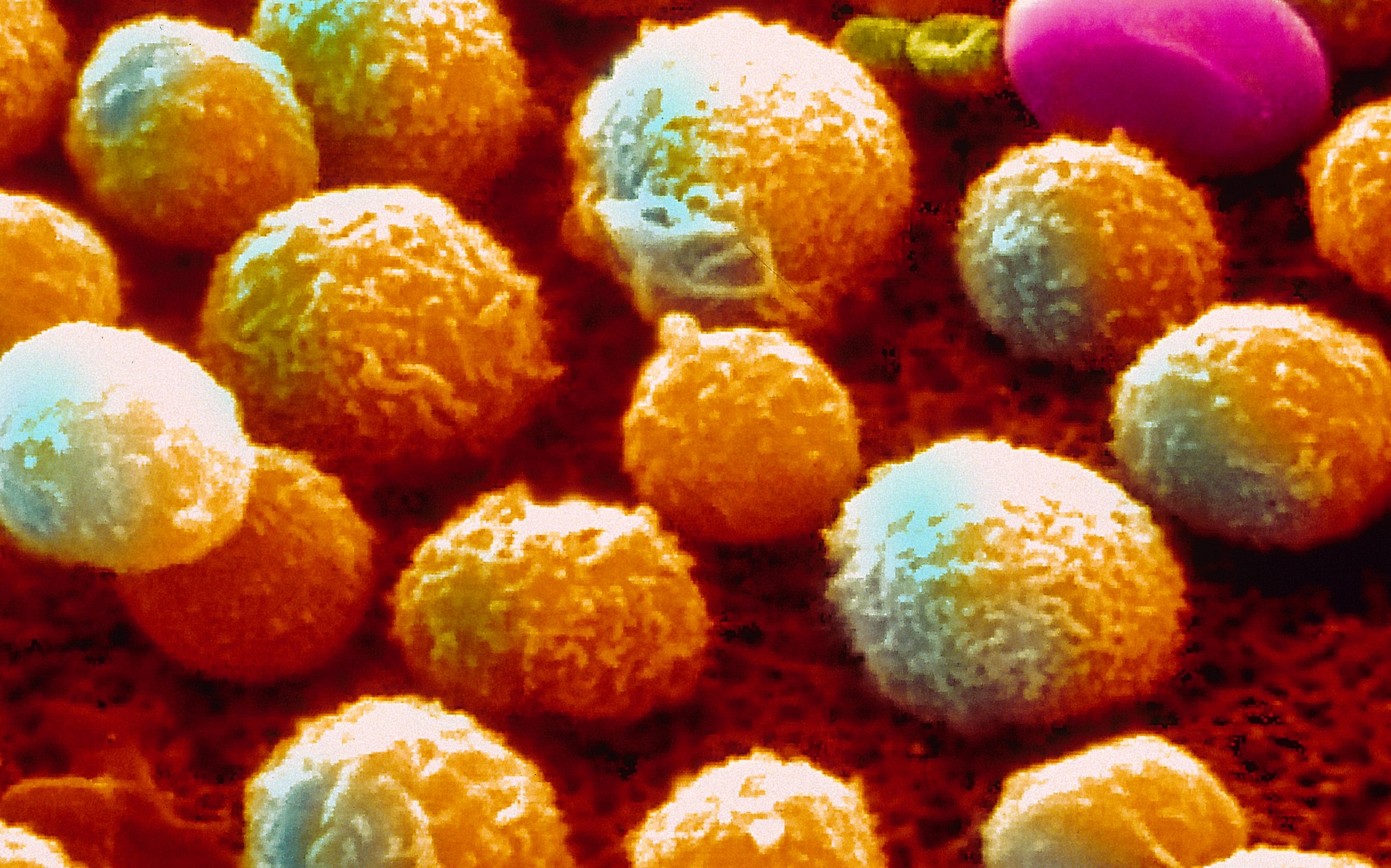 Chronic leukemia as seen under a scanning electron microscope.