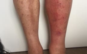 Bruising and cellulitis brings the trail to a temporary halt.