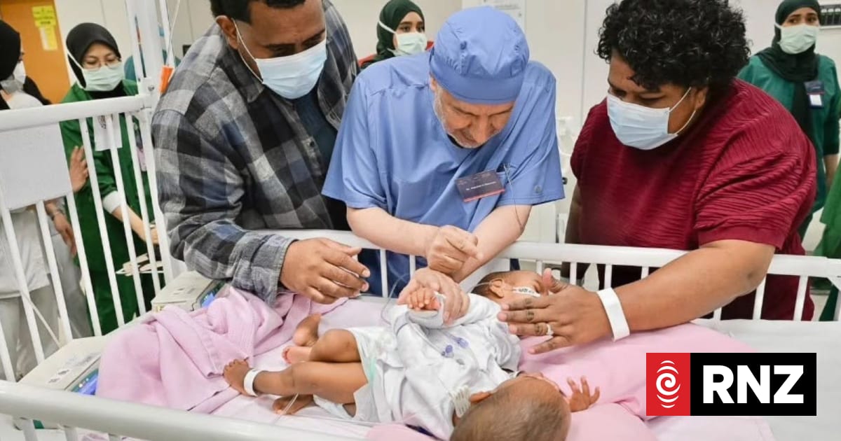 From tearful scans to tears of joy for mother of conjoined babies