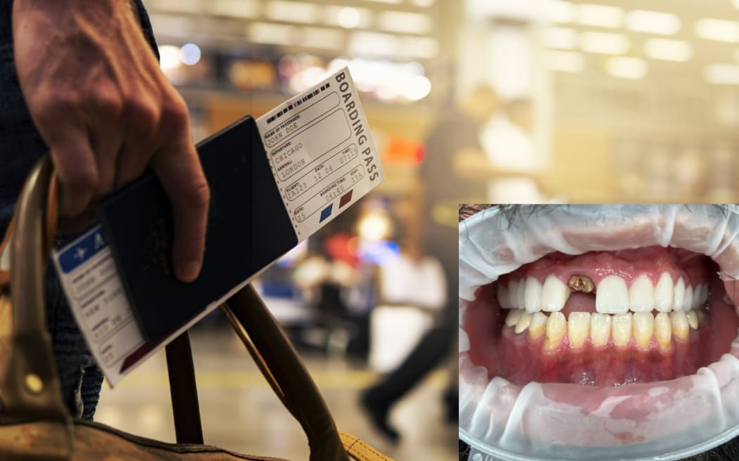 A patient of Dr Saud Ibrahim, who had rotting teeth underneath his veneers, done overseas.