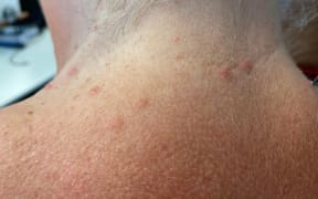 Tiny almost-invisible jellyfish silently stung Uretiti Beach swimmers such as this beachgoer on Saturday (SUBS: Jan 10 26) Photo Susan Botting Local Democracy Reporter Northland - single use only